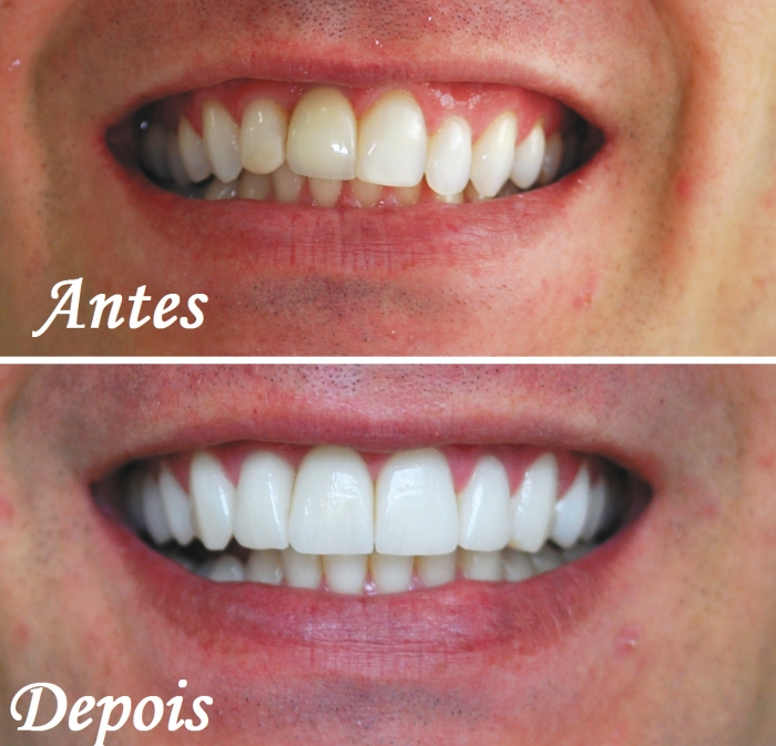 Lentes de contato: Você gostaria de melhorar seu sorriso?