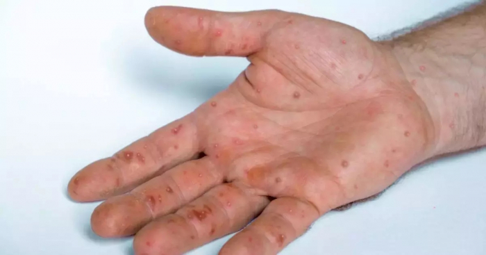 Indaial registra dois casos positivos de varíola dos macacos