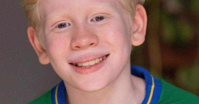 O que é albinismo? Entenda condição genética de Cristian, retratada em ‘Terra e Paixão’